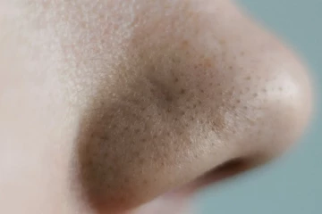 மூக்கிலுள்ள கரும்புள்ளிகள் முக அழகை கெடுக்கின்றதா?