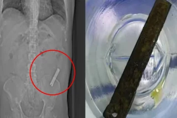 8 ஆண்டுகளாக வயிற்றில் இருந்த நகவெட்டி! கோபத்தில் எடுத்த முடிவால் நேர்ந்த சோகம்