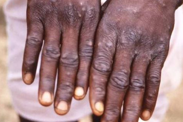 காற்று மூலம் பரவுகிறதா குரங்கு அம்மை - WHO எச்சரிக்கை! | Monkeypox Cases Reported To Who