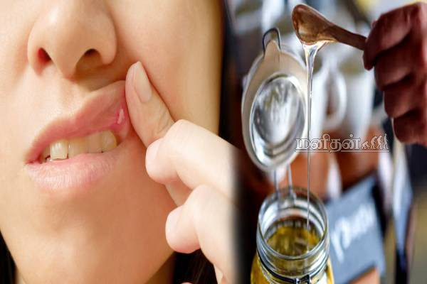 அடிக்கடி வாய்ப்புண் வருதா? ஒரே தடவையில் ஆற்றும் மருந்து உங்க வீட்டு சமையல் இருக்கே | Home Remedies To Treat Mouth Ulcers அடிக்கடி வாய்ப்புண் வருதா? ஒரே தடவையில் ஆற்றும் மருந்து உங்க வீட்டு சமையல் இருக்கே | Home Remedies To Treat Mouth Ulcers