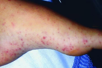 தீவிரமாக பரவும் மற்றுமொரு நோய் தொற்று! மக்களுக்கு விடுக்கப்பட்டுள்ள எச்சரிக்கை