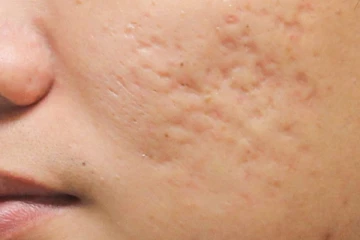 முகத்தில் உள்ள நாள்பட்ட தழும்புகளை மறைக்க வேண்டுமா? இதோ சூப்பர் டிப்ஸ்!