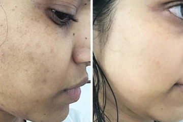 கரும்புள்ளியை போக்க அடித்து விரட்ட வெங்காயமும் பூண்டும் போதும்! இப்படி யூஸ் பண்ணுங்க