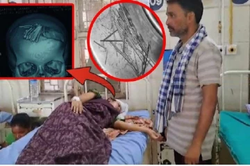 பெண்ணின் மண்டை ஓட்டிலிருந்து அகற்றப்பட்ட 77 ஊசிகள் : மருத்துவர்கள் அதிர்ச்சி