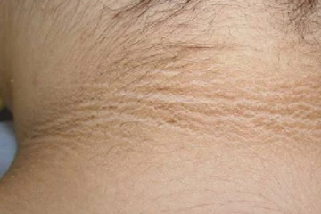 கழுத்து கருப்பா இருக்கா? இந்த பொருளை அப்படியே தடவி விடுங்க..அரை நொடியில் அதிசயம் தெரியும்!