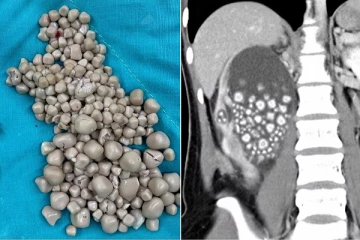 இருபது வயது பெண்னின் சிறுநீரகத்திலிருந்து அகற்றப்பட்டுள்ள 300 கற்கள்