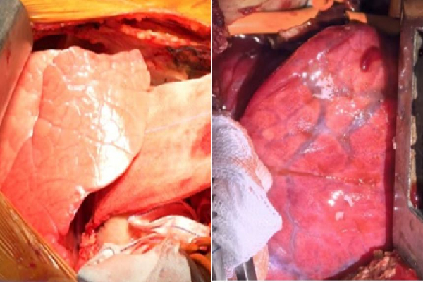 சீன மருத்துவர்கள் படைத்த சாதனை | China Doctors Successfully Implant Pigs Lung Human