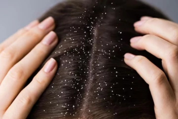 இந்த ஹேர் பேக் இருந்தால் போதும்.., பொடுகு பிரச்சனை உடனே குறையும்