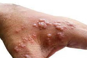 குரங்கம்மையின் அறிகுறிகள் என்னென்ன தெரியுமா?