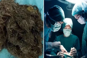 சிறுமியின் வயிற்றில் மூன்று கிலோ தலைமுடி - வெளிவந்த திடுக்கிடும் தகவல்