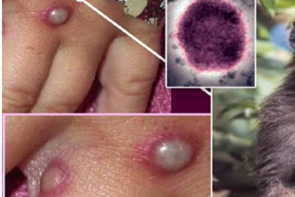 ஆட்டிப் படைக்கும் குரங்கு அம்மை! நோய் பாதித்தால் என்ன செய்ய வேண்டும்? | Monkeypox Symptoms Treatment In Tamil