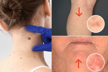 චර්ම පිළිකාවක් හඳුනාගත හැකි ලක්ෂණ.