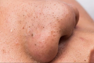 பருக்களால் உருவான கரும்புள்ளிகள் போக்க வேண்டுமா? இதோ அருமையான சில வழிகள்