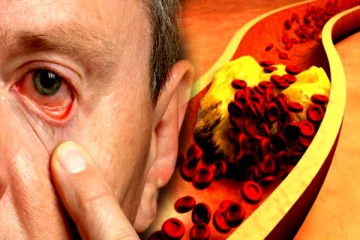 கொலஸ்ட்ரால் கண்களை பாதிக்குமா? திடுக்கிடும் மருத்துவ தகவல்கள்!