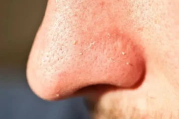 உங்க மூக்கைச் சுற்றி வெள்ளையா சொரசொரன்னு அசிங்கமா இருக்கா? இதனை எப்படி போக்கலாம் தெரியுமா?