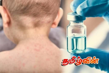 அமெரிக்காவின் தென் கரோலினா மாகாணத்தில் வேகமாக பரவும் தட்டம்மை நோய்