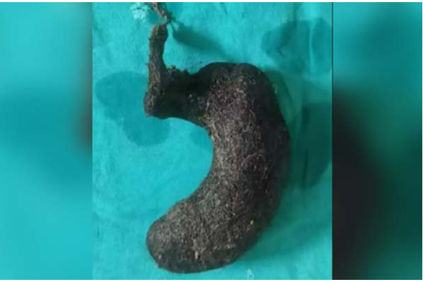 சாப்பிடாமல் இருந்த சிறுமி: மருத்துவமனையில் காத்திருந்த பேரதிர்ச்சி! வயிற்றில் இருந்தது என்ன தெரியுமா? | Doctors Remove Hairball Girl Stomach