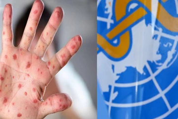 குரங்கம்மைக்கு புதிய பெயர் சூட்டப்பட்டது! உலக சுகாதார நிறுவனம் அறிவிப்பு