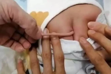 10 செ.மீ அளவு வாலுடன் பிறந்த குழந்தை!