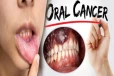 இந்த அறிகுறிகள் இருக்கா? அப்போ வாய் புற்றுநோய் அபாயம் உறுதி