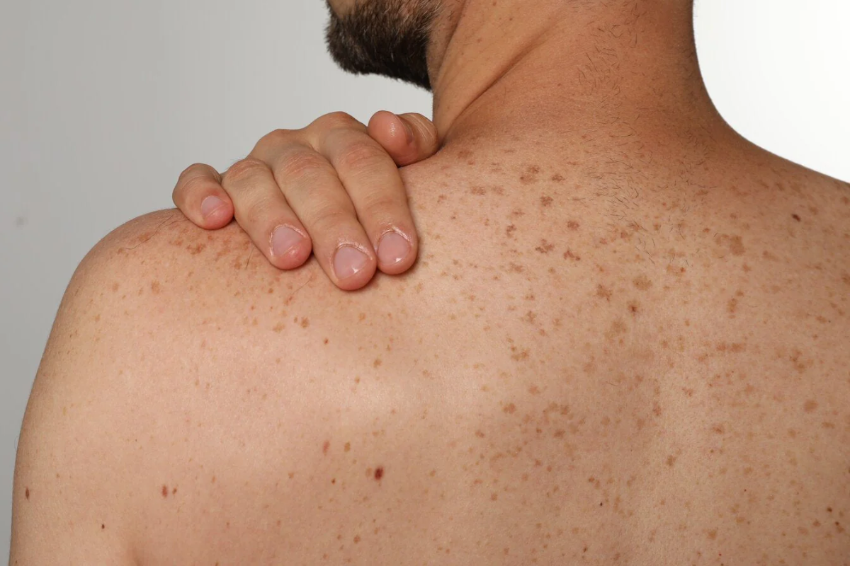 சூரிய ஒளியினால் ஏற்படக்கூடிய ஆபத்து குறித்து எச்சரிக்கை | Skin Cancer Awareness