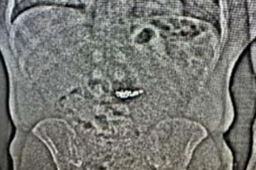 நான்கு வைரக்கம்மல்களைத் திருடிவிட்டு தப்பிய நபர்: எக்ஸ்ரேயில் தெரிந்த காட்சி