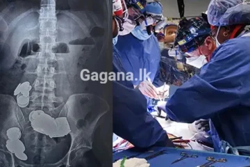 ලොවම පුදුම කරමින් තරුණයෙකුගේ බඩෙන් කාසි 39ක් හා කාන්දම් 37ක් එළියට ගනී..!