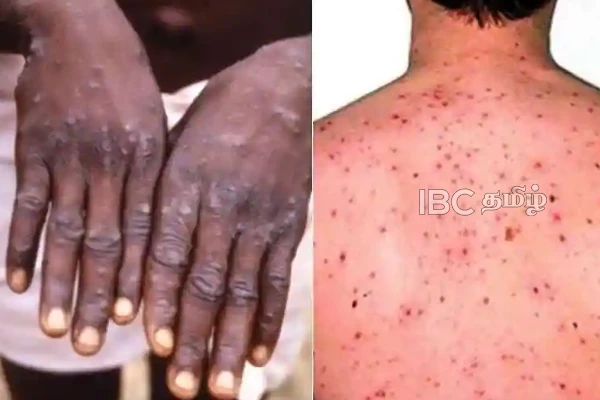 வேகமெடுக்கும் குரங்கு அம்மை நோய்! உலக சுகாதார அமைப்பு தகவல் | 14000 Cases Of Monkeypox Worldwide