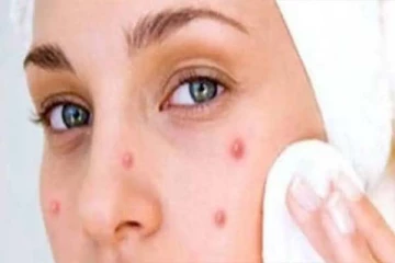 நீங்கள் செய்யும் இந்த தவறுகள் முகப்பருவிற்கு முக்கிய காரணம்! என்னென்னனு தெரிஞ்சிக்கோங்க