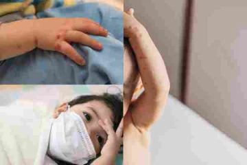 குழந்தைகளிடையே பரவும் புதிய நோய்த்தொற்று : எச்சரிக்கும் வைத்தியர்கள்!