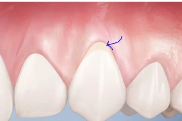 பற்களின் பின் இருக்கும் மஞ்சள் கறையைப் போக்க இந்த ஒரே ஒரு வழி போதும்.... இனி வாய்விட்டு சிரிக்கலாம்!