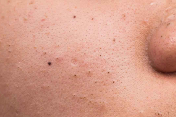 சரும பிரச்சனைகளுக்கு தீர்வு தரும் தக்காளி மஞ்சள் | Tomato Turmeric Is A Remedy For Skin Problems