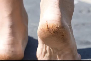 பாதங்களை வெடிப்பின்றி மிருதுவாக வைத்து கொள்ள வேண்டுமா? இதோ சூப்பரான டிப்ஸ்!