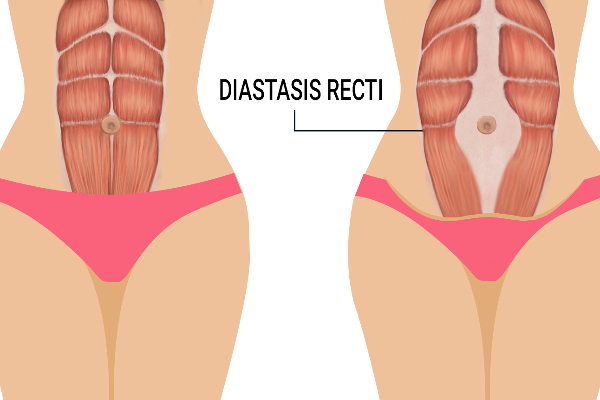 பிரசவத்துக்குப் பிறகு தளர்ந்த வயிறு சரியாகனுமா ! | Is The Loose Stomach Ok After Childbirth