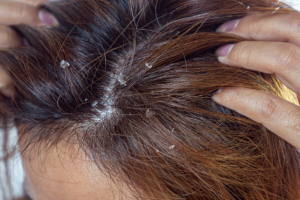 தலைகுளிப்பதற்கு வெந்நீர் பயன்படுத்தலாமா? அவசியம் தெரிஞ்சுக்கோங்க | Can Use Hot Water To Wash Hair Dovtor Warning தலைகுளிப்பதற்கு வெந்நீர் பயன்படுத்தலாமா? அவசியம் தெரிஞ்சுக்கோங்க | Can Use Hot Water To Wash Hair Dovtor Warning