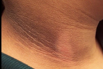 கழுத்தை சுற்றி உள்ள கருப்பை எப்படி போக்கலாம்? கட்டாயம் இதை செய்தால் போதும்