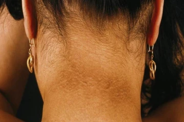 கழுத்தின் நிறம் கருப்பாக இருக்கிறதா? - உடனே இந்த வீட்டு வைத்தியத்தை செய்யவும்