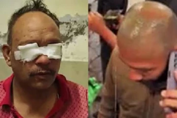 முடி வளர்ச்சிக்கு பயன்படுத்தபட்ட மருந்து..10 நிமிடத்தில் கண்களில் வீக்கம் - அதிர்ச்சி சம்பவம்!