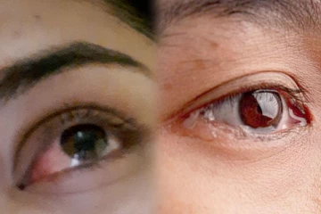 புதிதாக பரவும் கண் நோய்; சுகாதார அமைச்சு வெளியிட்ட முக்கிய அறிவிப்பு!