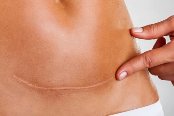 உடலில் வரும் தழும்புகளை எப்படி எளிய முறையில் தீர்க்கலாம்?