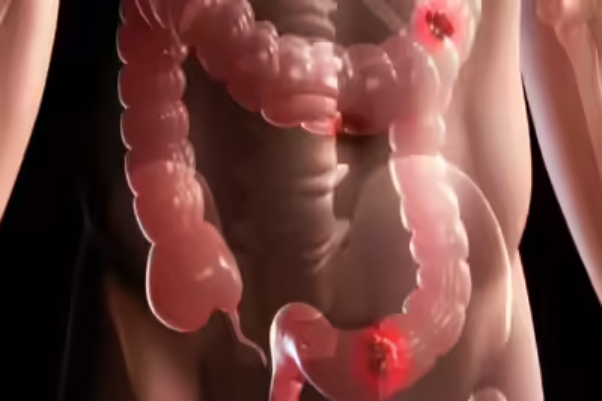 பெருங்குடல் புற்றுநோயின் அறிகுறிகள் என்னென்ன? | What Are The Symptoms Of Colon Cancer