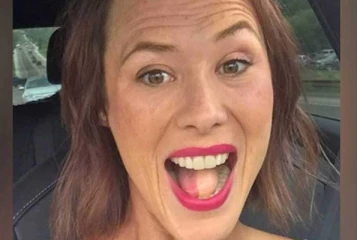 புற்றுநோய் பாதித்த பெண்ணுக்கு நாக்கில் முடி வளர்ந்த சம்பவம் - அதிர்ச்சியடைந்த மருத்துவர்கள்