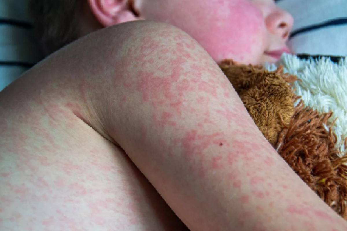 பங்களாதேஷை உலுக்கும் தட்டம்மை: 100க்கும் மேற்பட்ட சிறுவர்கள் பலி! | Measles Shakes Bangladesh 100 Children