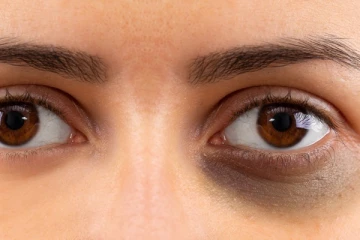 கண்ணை சுற்றிலும் கருப்பா அசிங்கமா இருக்கா? இதனை போக்க என்ன செய்யலாம்?