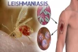 leishmaniasis-symptoms: லீஷ்மேனியாசிஸ் என்றால் என்ன? இந்த அறிகுறிகள் இருந்தா ஜாக்கிரதை!