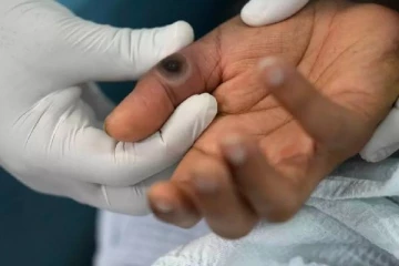 ஒரே வாரத்தில் 1,200 பேர்கள் பாதிப்பு... mpox தொற்றால் திணறும் ஒரு நாட்டின் மக்கள்