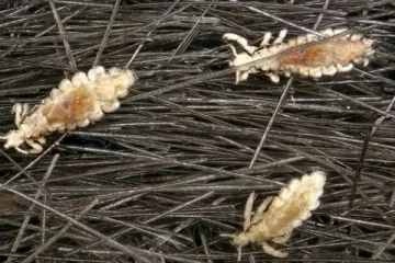 பேன் அதிகமாக தொல்லை கொடுக்குதா...இனி கவலைய விடுங்க!