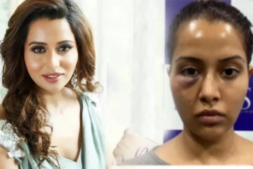 எப்படி இருந்த என் முகம் இப்படி ஆயிடுச்சு : நடிகை ரைசா புகைப்படத்தால் பரபரப்பு!