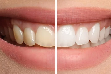 பற்களில் உள்ள கறைகளை நீக்கனுமா? சில எளிய டிப்ஸ்கள் இதோ