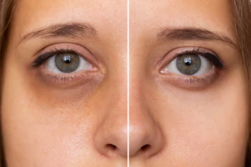 கருவளையத்தை நிரந்தமாக நீக்க இந்த ஒரு பொருள் போதும்: எப்படி பயன்படுத்துவது?